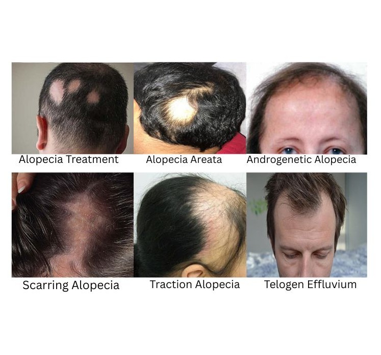 Alopecia treatment
